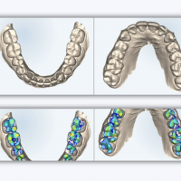 3d retainer thumb