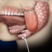 Xerostomia THUMB