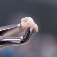 extractions